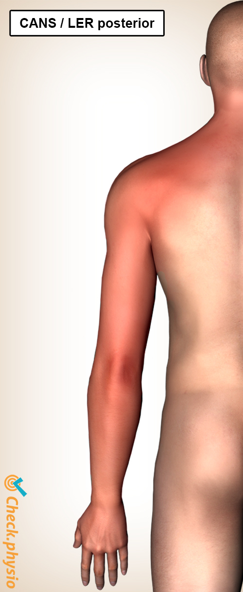ler rsi posterior