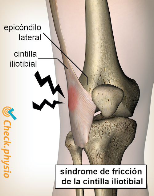 síndrome de la banda iliotibial de la rodilla epicóndilo lateral